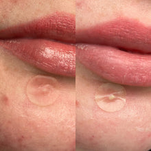 Load image into Gallery viewer, Split image showing the Hero Mighty Patch on the skin, demonstrating the visible absorption of pimple gunk as the clear patch turns white, confirming its hydrocolloid function.