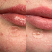 Load image into Gallery viewer, A split-screen comparison showing a blemish before and after using a hydrocolloid patch, with the patch appearing white as it absorbs fluid.