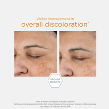Load image into Gallery viewer, Before and after comparison of facial skin with text indicating visible improvement in overall discoloration.
