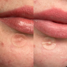 Load image into Gallery viewer, Split image showing the Hero Mighty Patch on the skin, demonstrating the visible absorption of pimple gunk as the clear patch turns white, confirming its hydrocolloid function.
