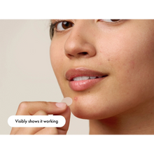 Load image into Gallery viewer, A close-up view of a person applying a discreet, circular pimple patch to a blemish on their chin.
